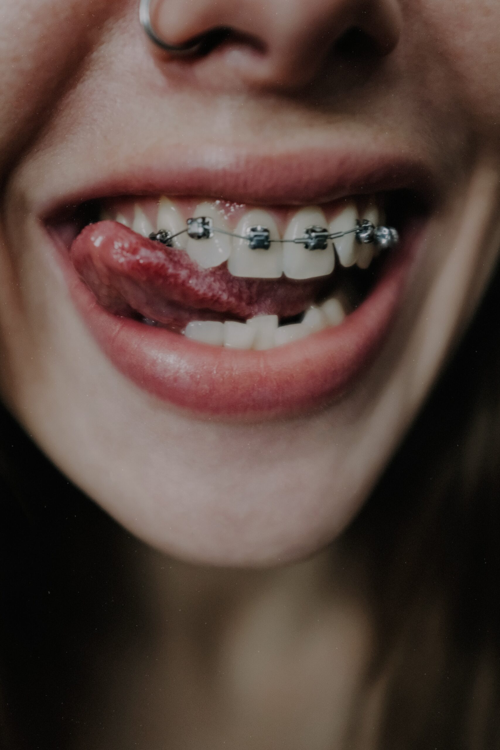 What Makes Clear Aligners a Popular Choice for Adult Orthodontic Treatment in Las Vegas
